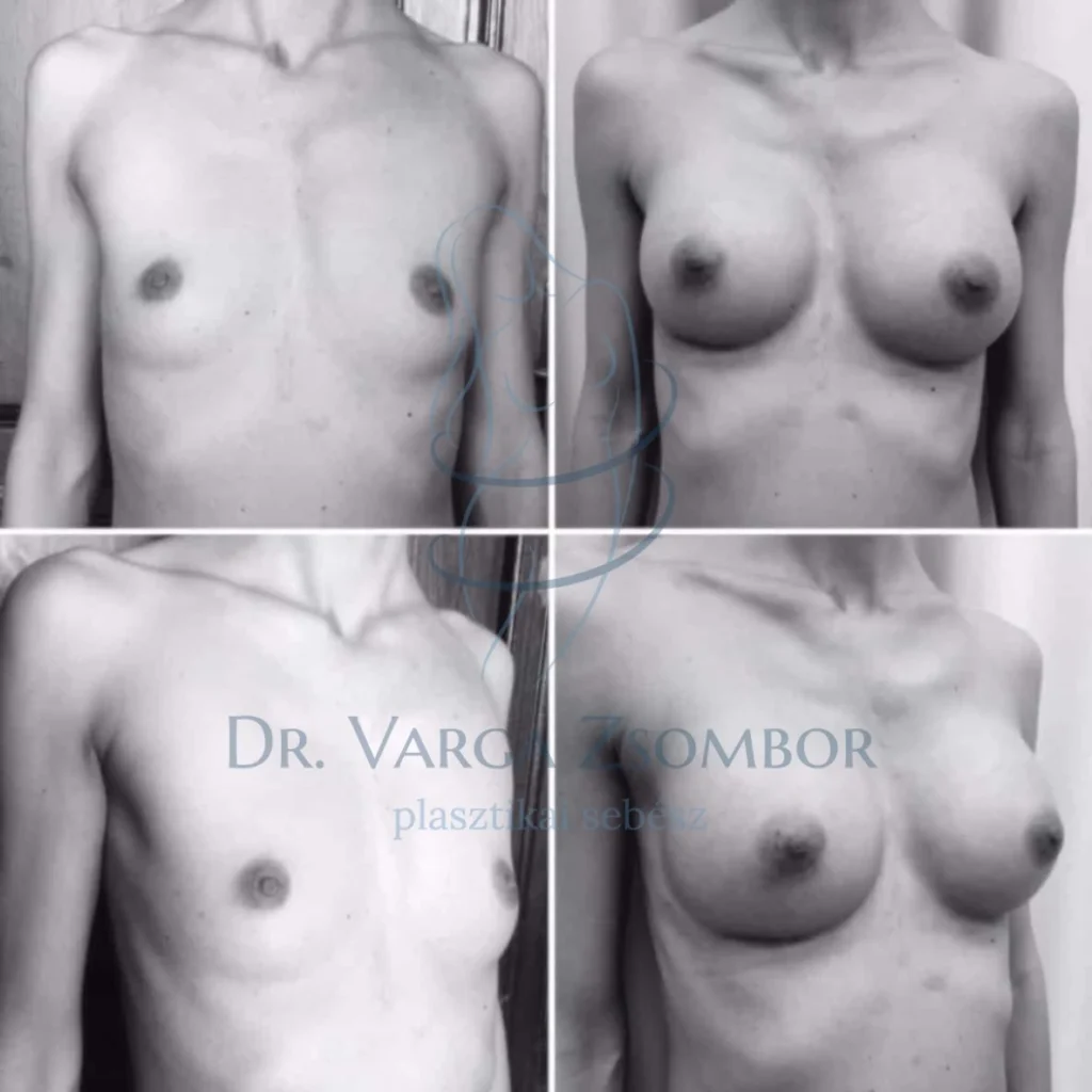 Mellplasztika előtte – utána képek