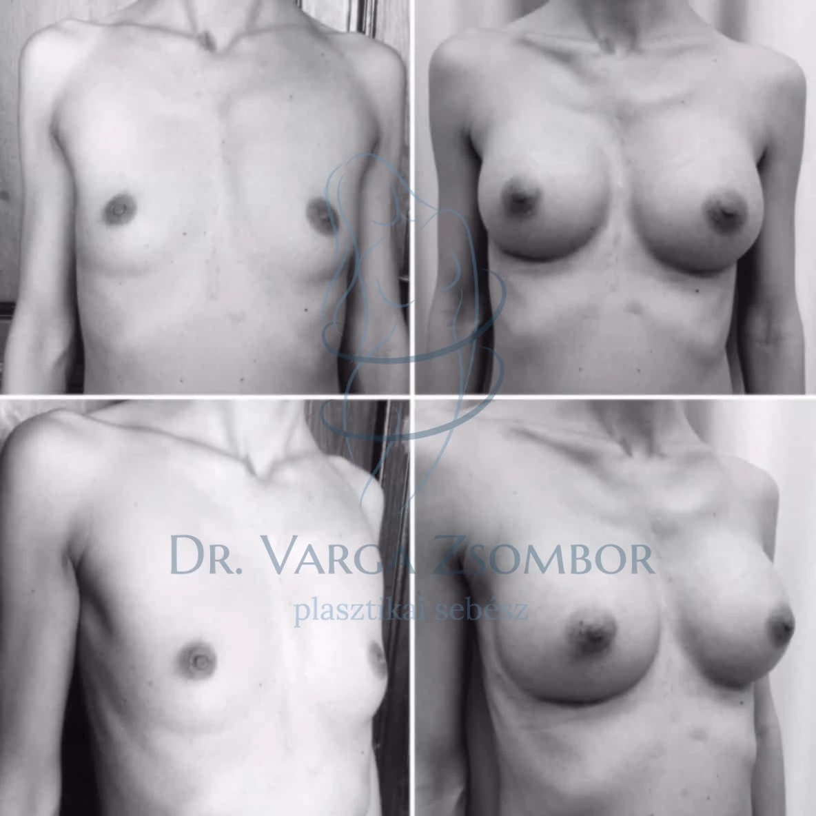 Mellplasztika előtte – utána képek
