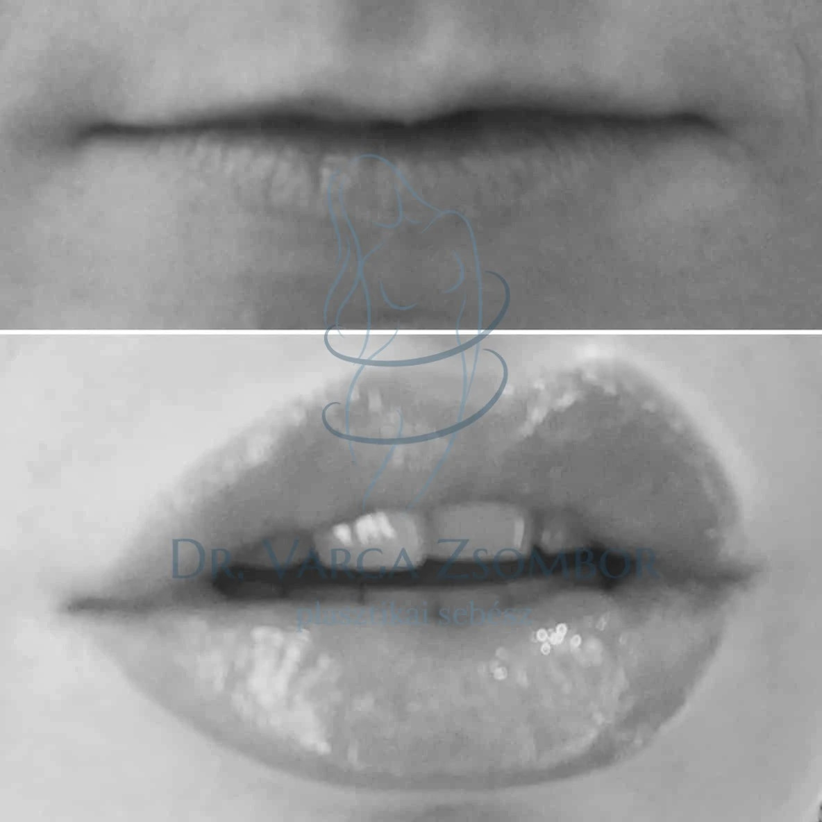 Igéző ajkak – kétféleképpen (előtte-utána képekkel)