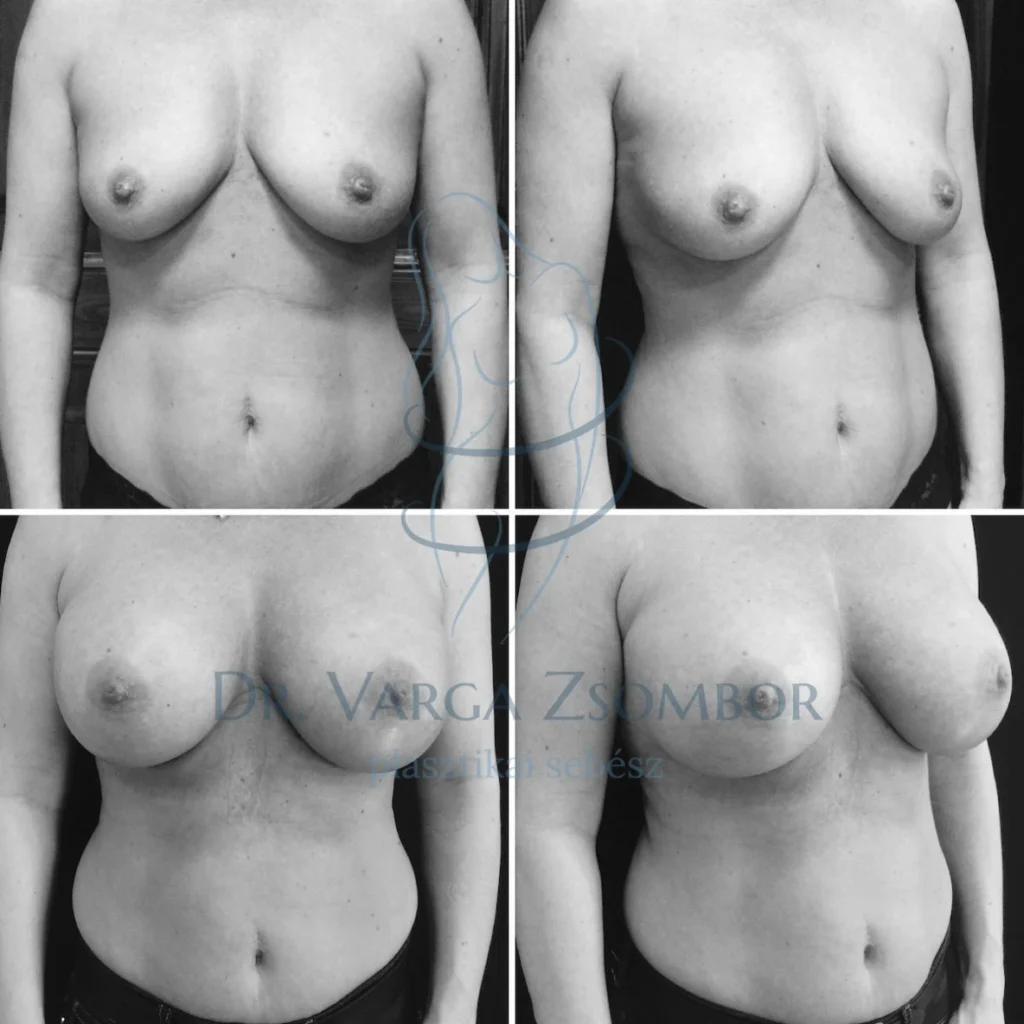 Szülés és szoptatás utáni mellek helyreállítása