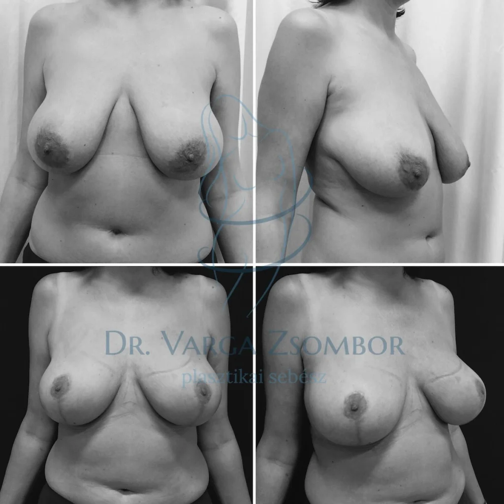 Újra feszesen – implantátumok nélkül