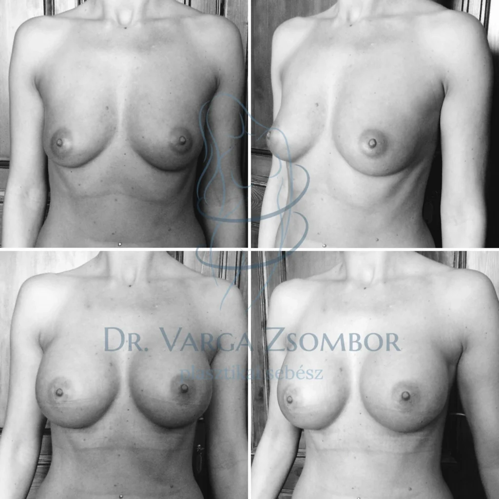 Az egyik legkeresettebb szépészeti beavatkozás: Mellnagyobbítás (előtte-utána képek)