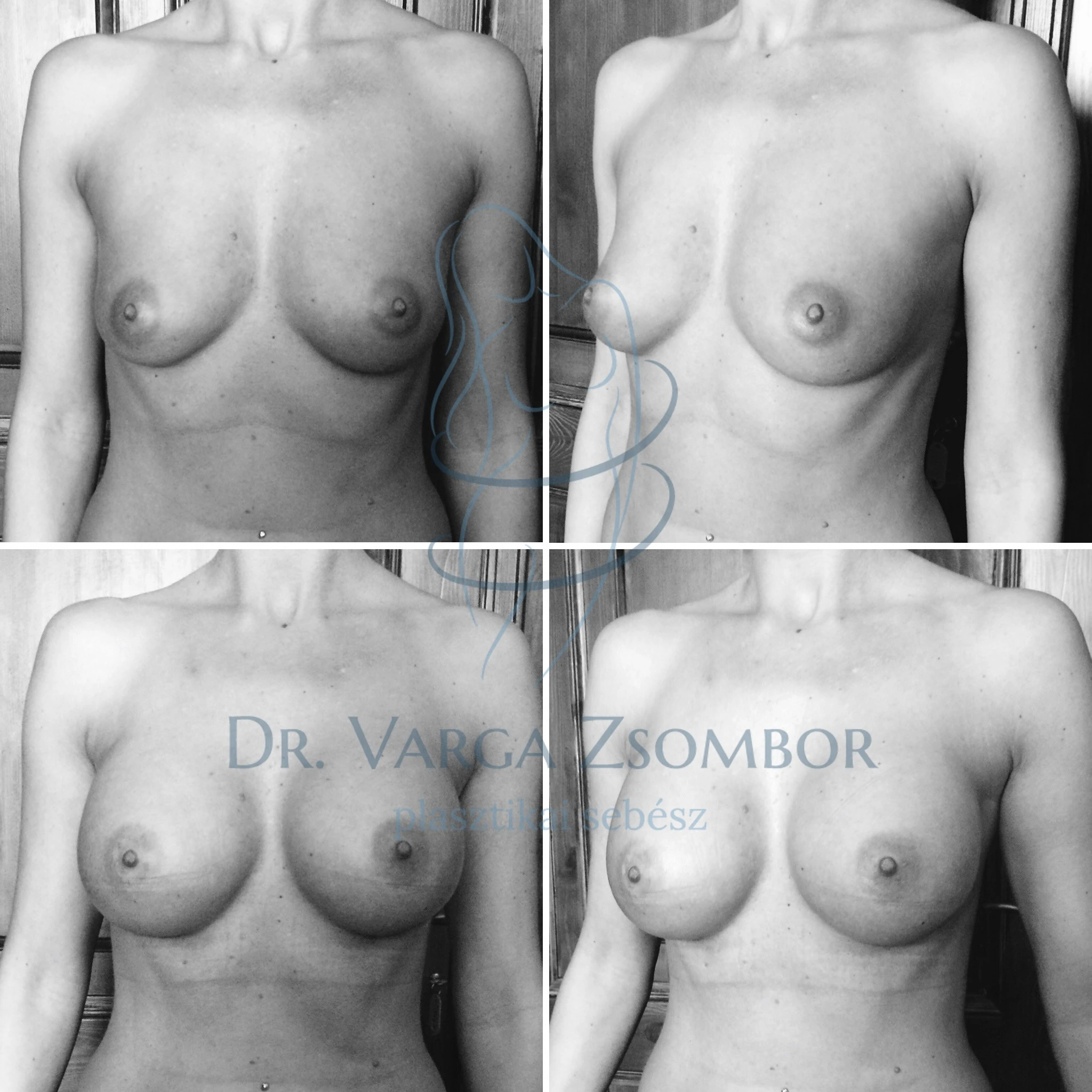 Az egyik legkeresettebb szépészeti beavatkozás: Mellnagyobbítás (előtte-utána képek)