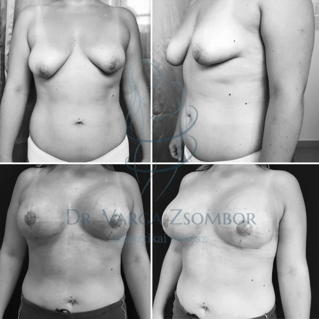 Jelentős fokú emlő aszimmetria, úgynevezett “csőmell” korrekciója