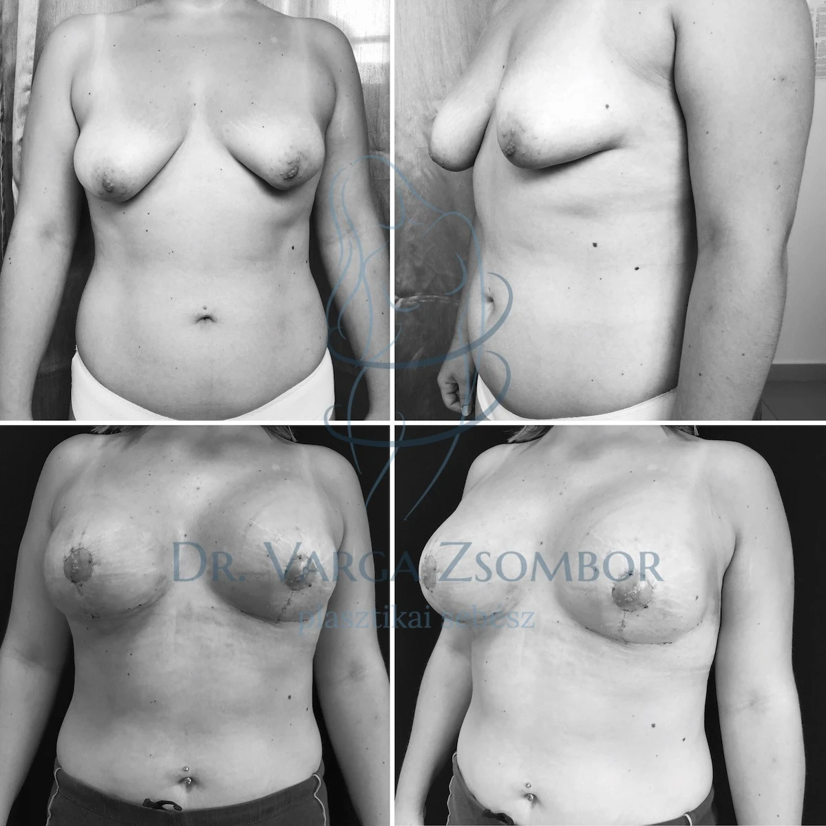 Jelentős fokú emlő aszimmetria, úgynevezett “csőmell” korrekciója