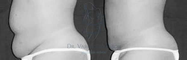 Mire jó a zsírleszívás?