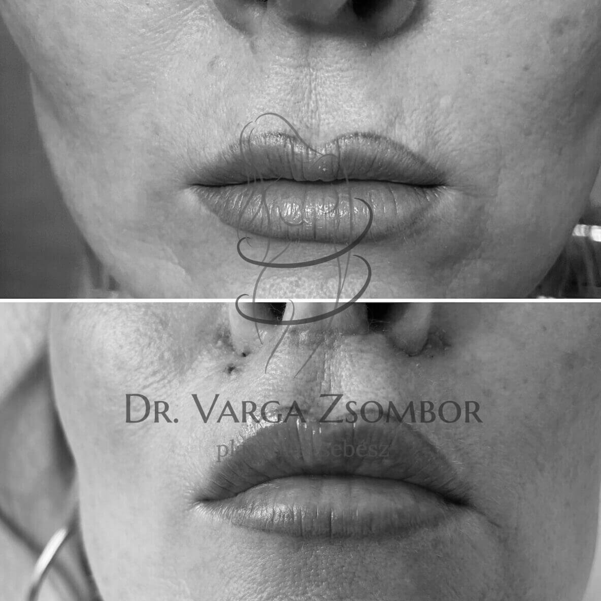 bullhorn lip lift, ajakpír emelés