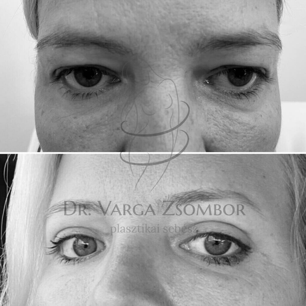 felső szemhéjplasztika előtte-utána