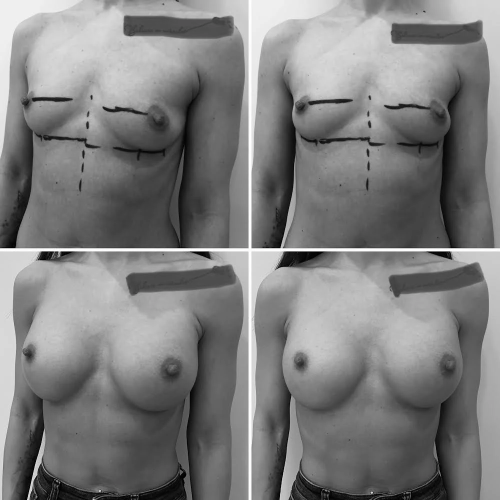 Fiatal, sportos testalkatú hölgy testarányos mellnagyobbítása