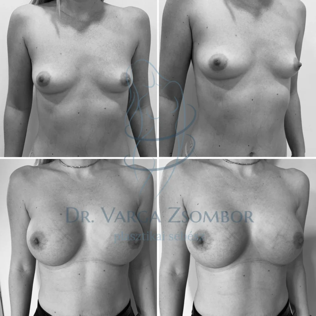 Mellimplantátum szoptatás után