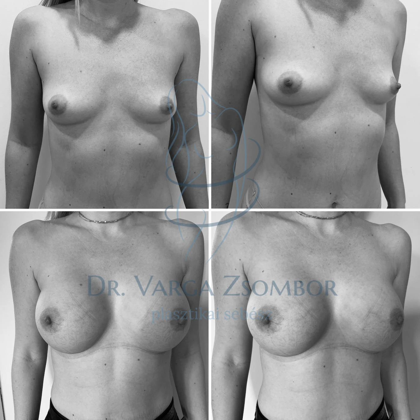 Mellimplantátum szoptatás után