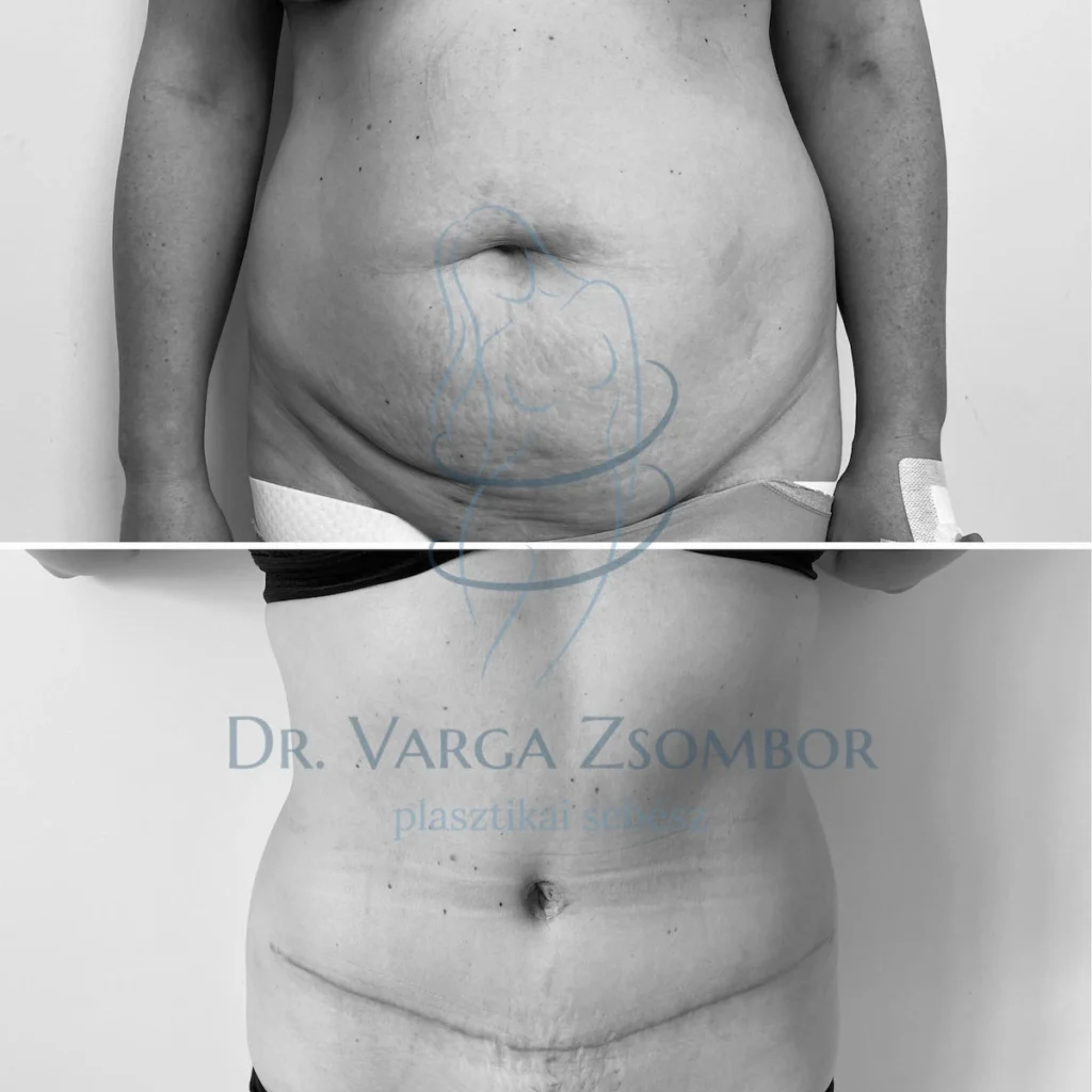 Teljes hasplasztika zsírleszívással kombinálva (előtte-utána képpel)