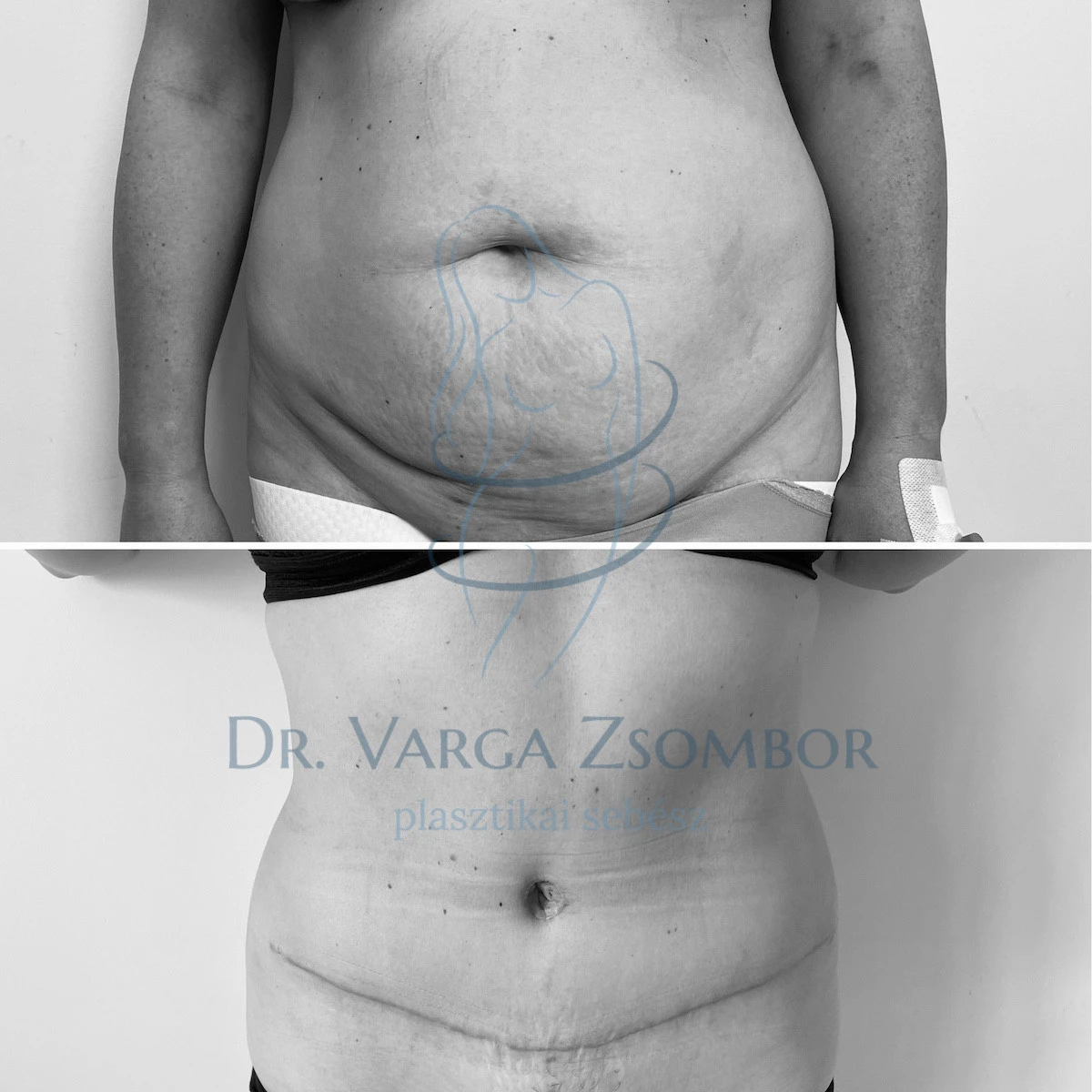 Teljes hasplasztika zsírleszívással kombinálva (előtte-utána képpel)