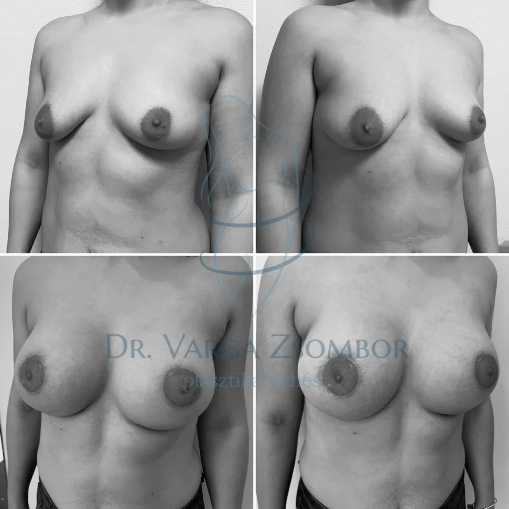 Enyhe aszimmetria, enyhe megereszkedés, enyhén tubuláris mell megszépítése 450cc kerek, magas implantátumokkal és Benelli-féle bimbókorrekcióval