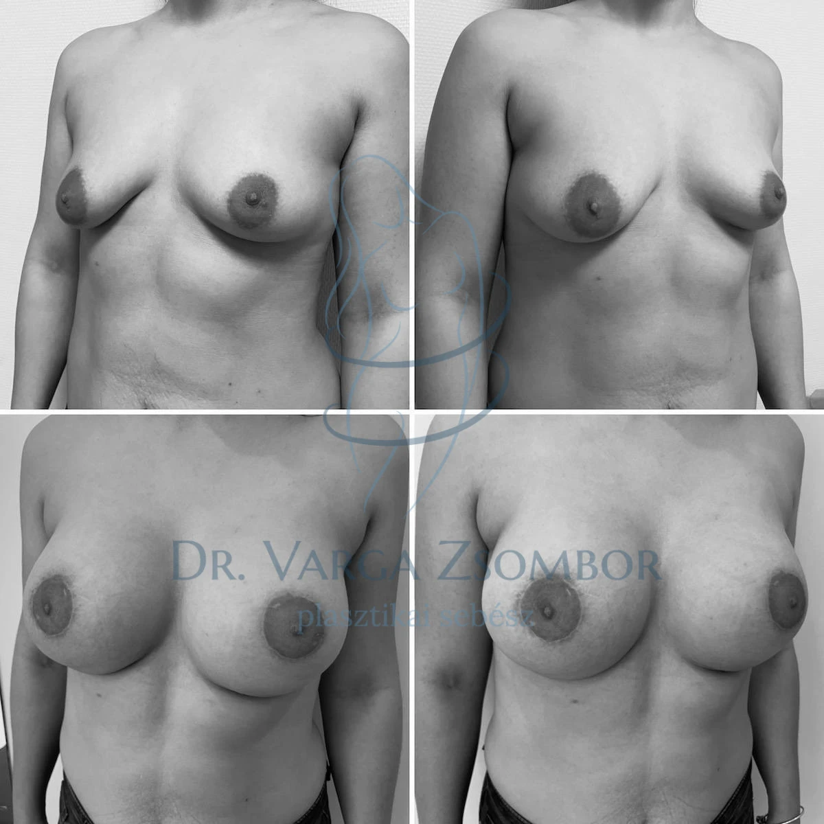 Enyhe aszimmetria, enyhe megereszkedés, enyhén tubuláris mell megszépítése 450cc kerek, magas implantátumokkal és Benelli-féle bimbókorrekcióval