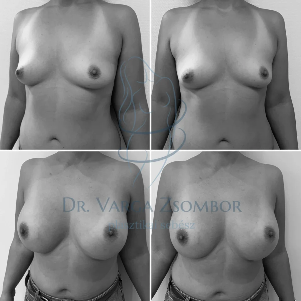 Mellplasztika után