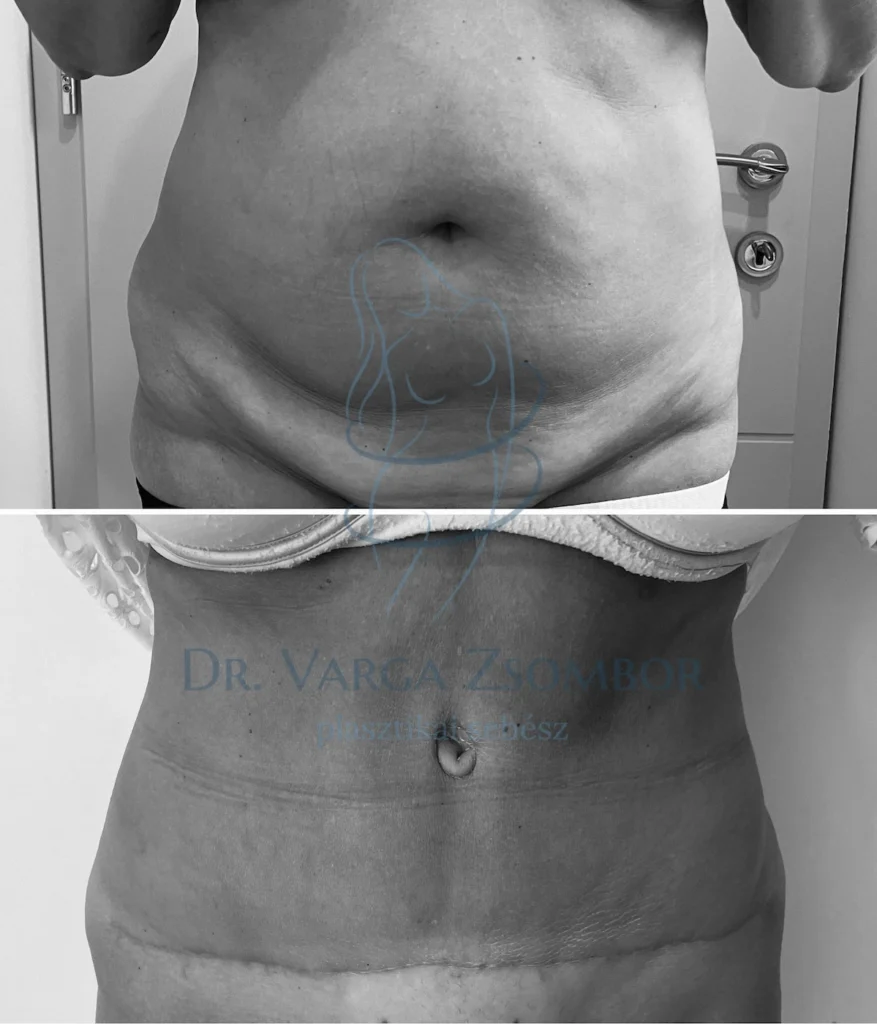 Teljes hasplasztika zsírleszívással