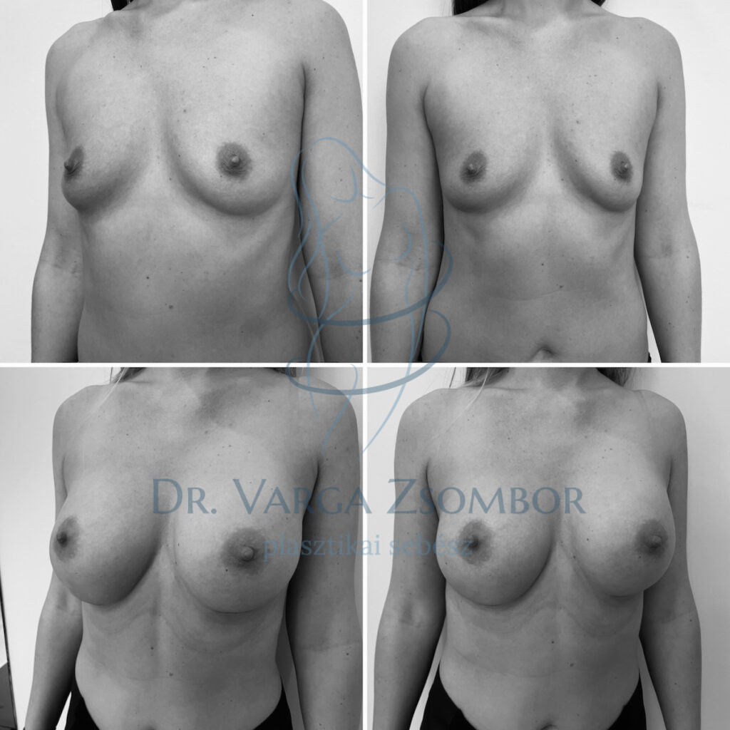 Kerek mellimplantátum