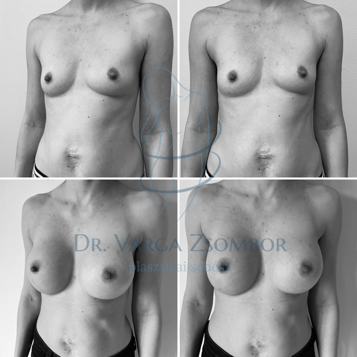 Mell aszimmetriától a szimmetriáig (előtte-utána fotó)