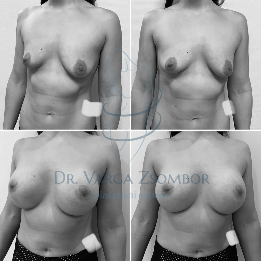 Testarányos mellnagyobbítás – képek