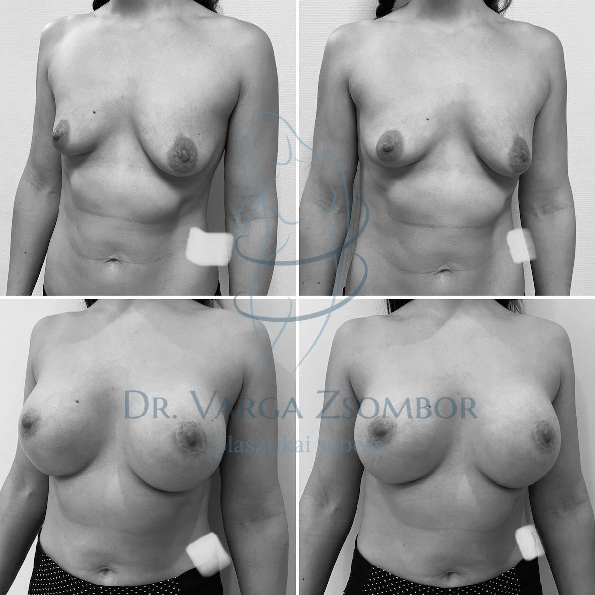 Testarányos mellnagyobbítás – képek