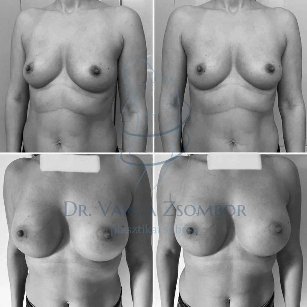 Formásabb keblek – itt középmagas mellimplantátumokkal
