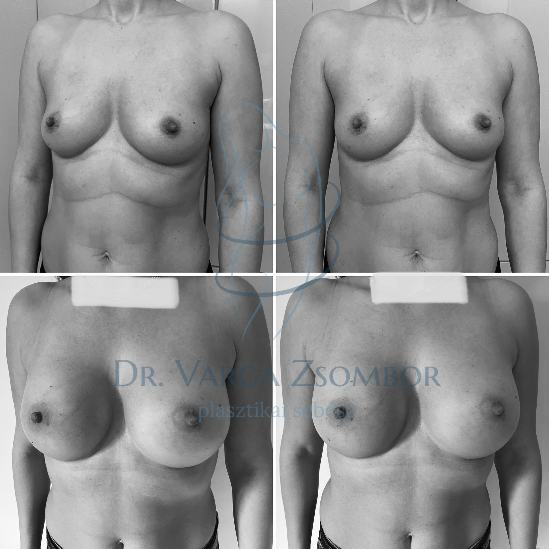 Formásabb keblek – itt középmagas mellimplantátumokkal