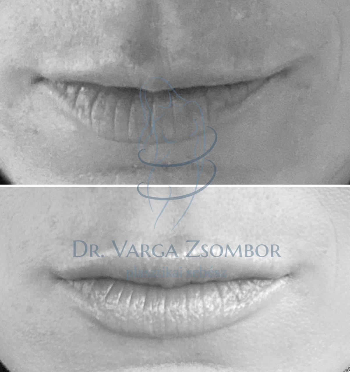 Mire képes 0.7ml az ajkakban?