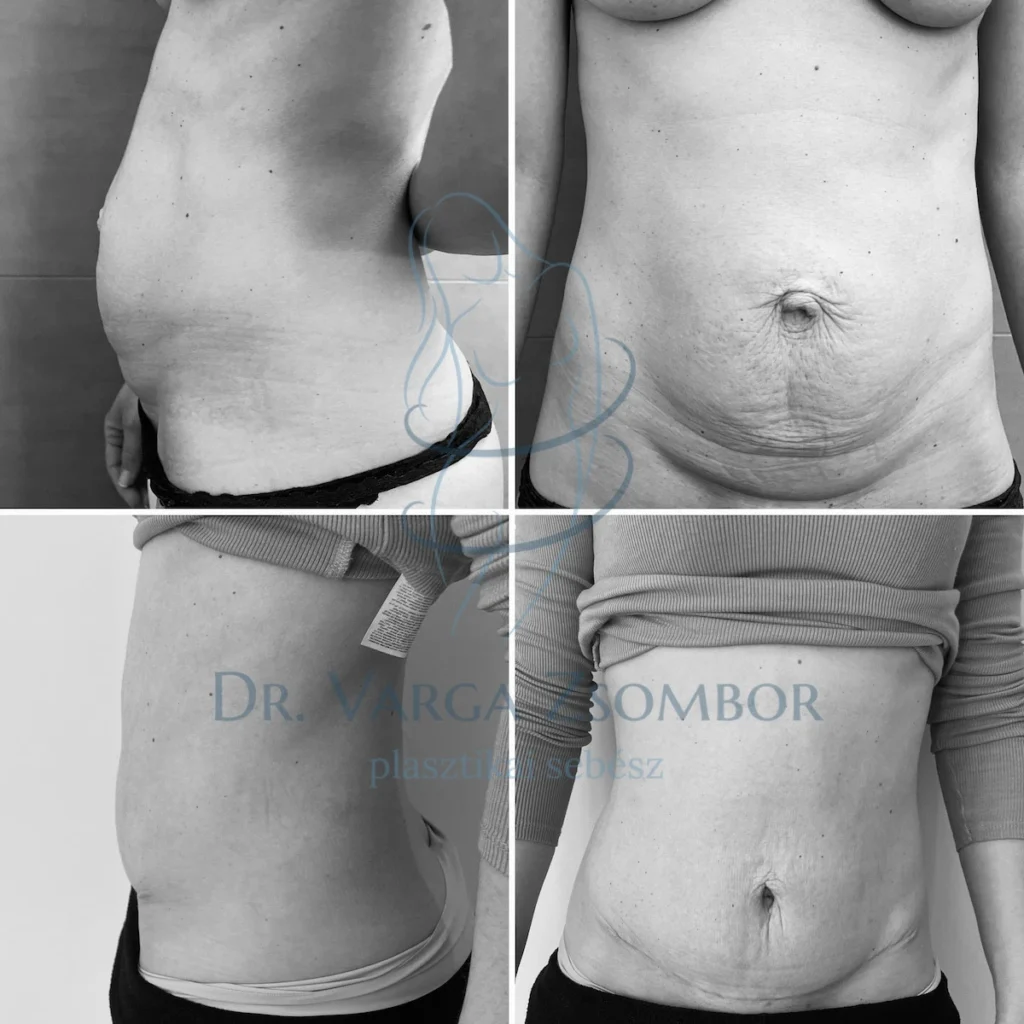 Midi hasplasztika 3 gyermek után