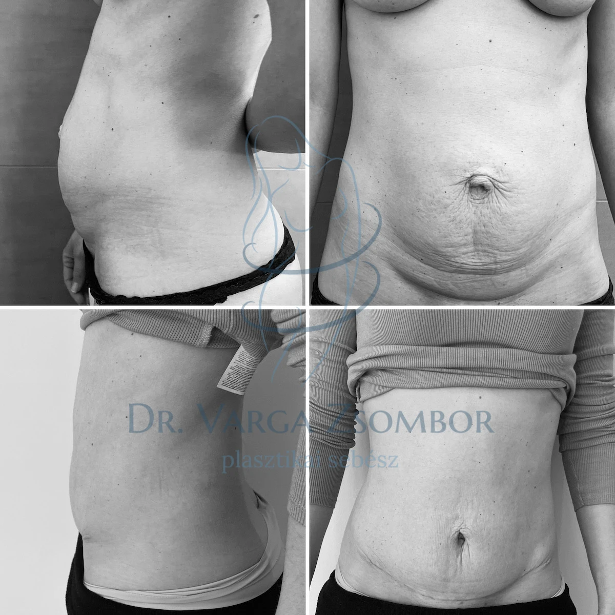 Midi hasplasztika 3 gyermek után