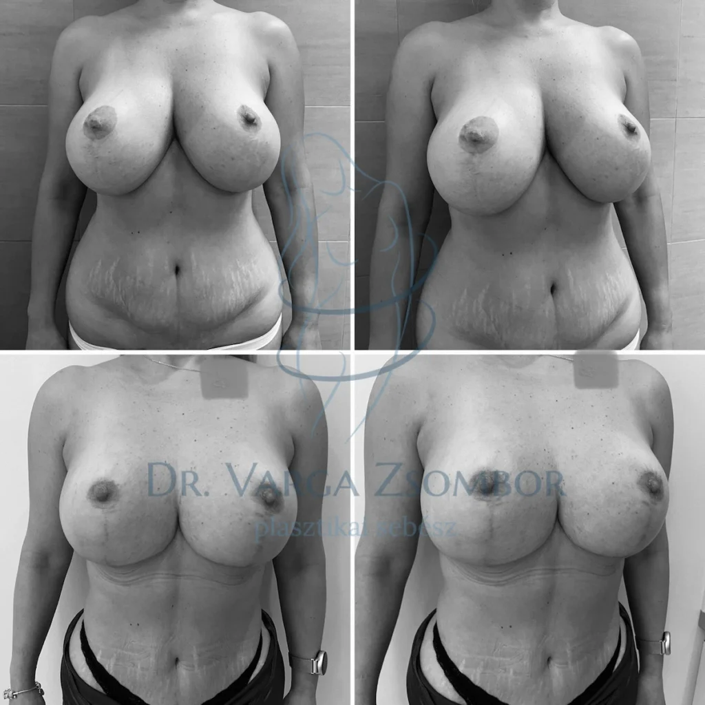 Mellkisebbítés és hasplasztika egyben