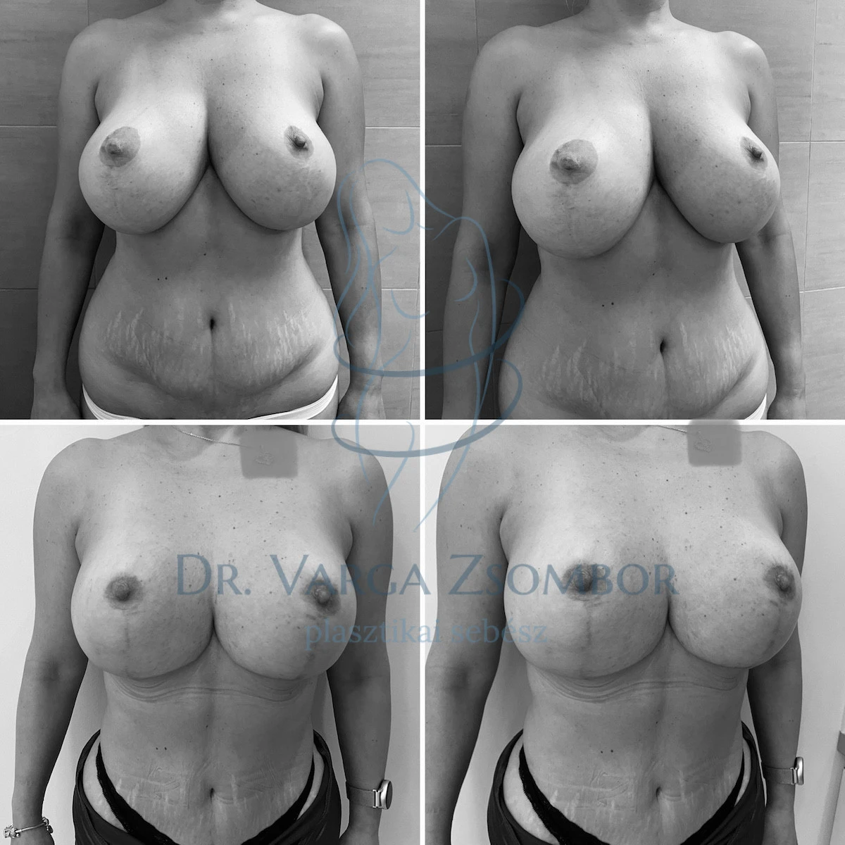 Mellkisebbítés és hasplasztika egyben