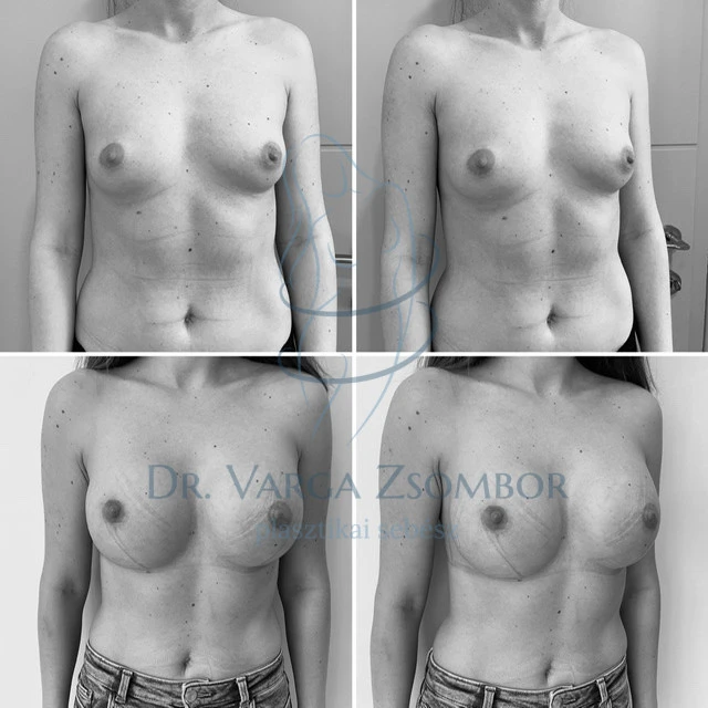 Mellnagyobbítás után