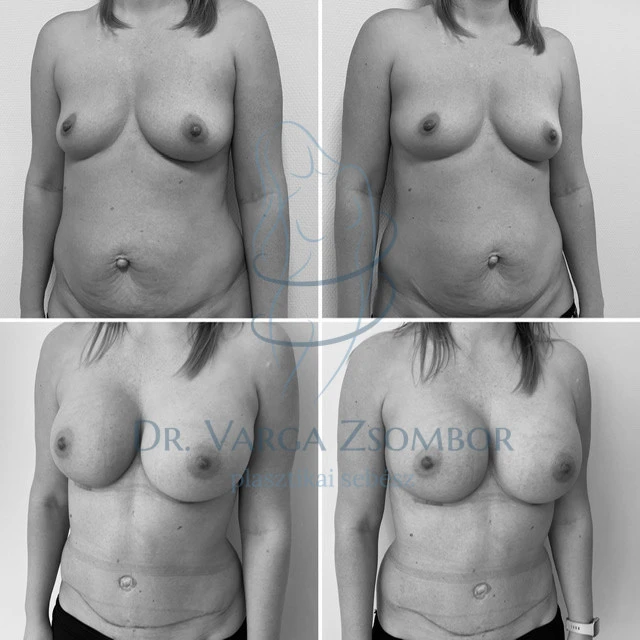 Has+mellplasztika kombinált műtét (előtte-utána kép)