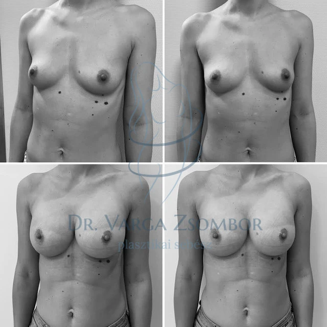 325cc, középmagas implantátum (előtte-utána fotó)