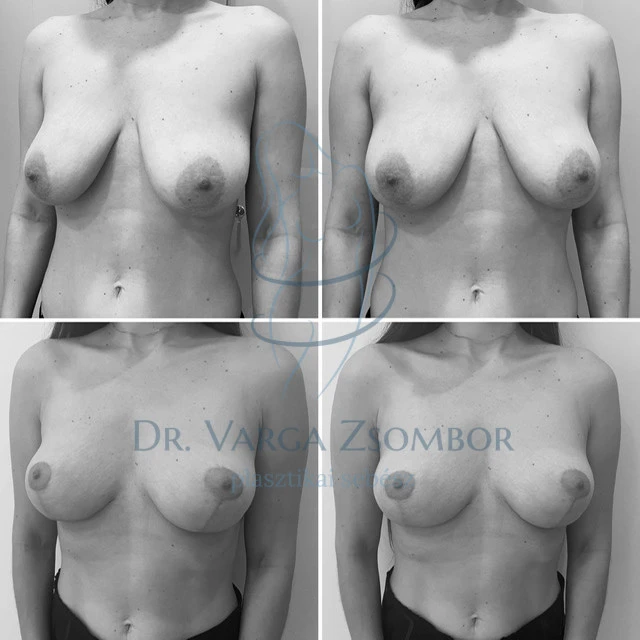 Mellfelvarrás előtt és után