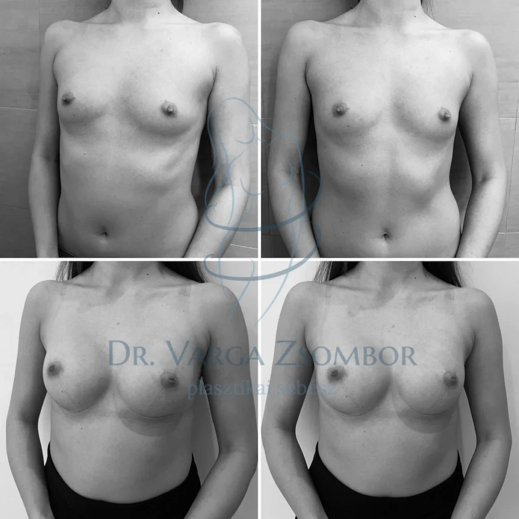 Mellplasztika 200cc implantátummal