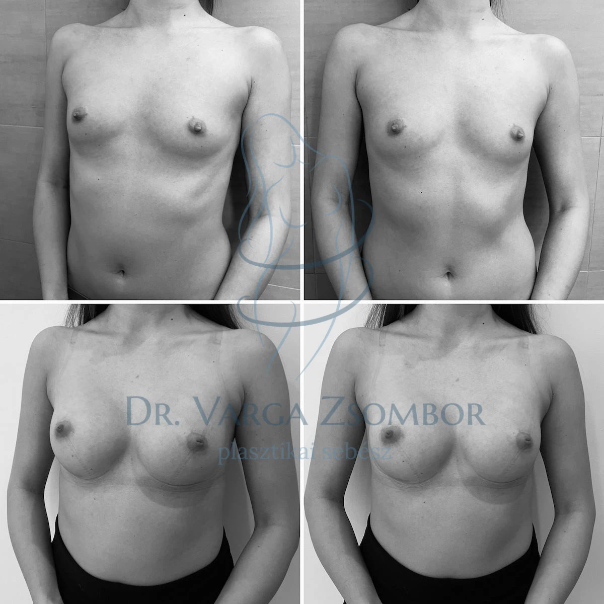 Mellplasztika 200cc implantátummal