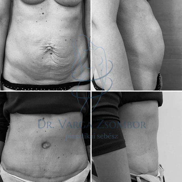 Teljes hasplasztika-szétnyílt hasizom műtéti megoldásával