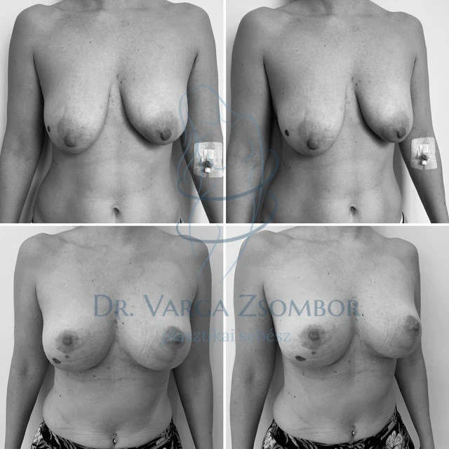 Mellfelvarrás előtte-utána képpel