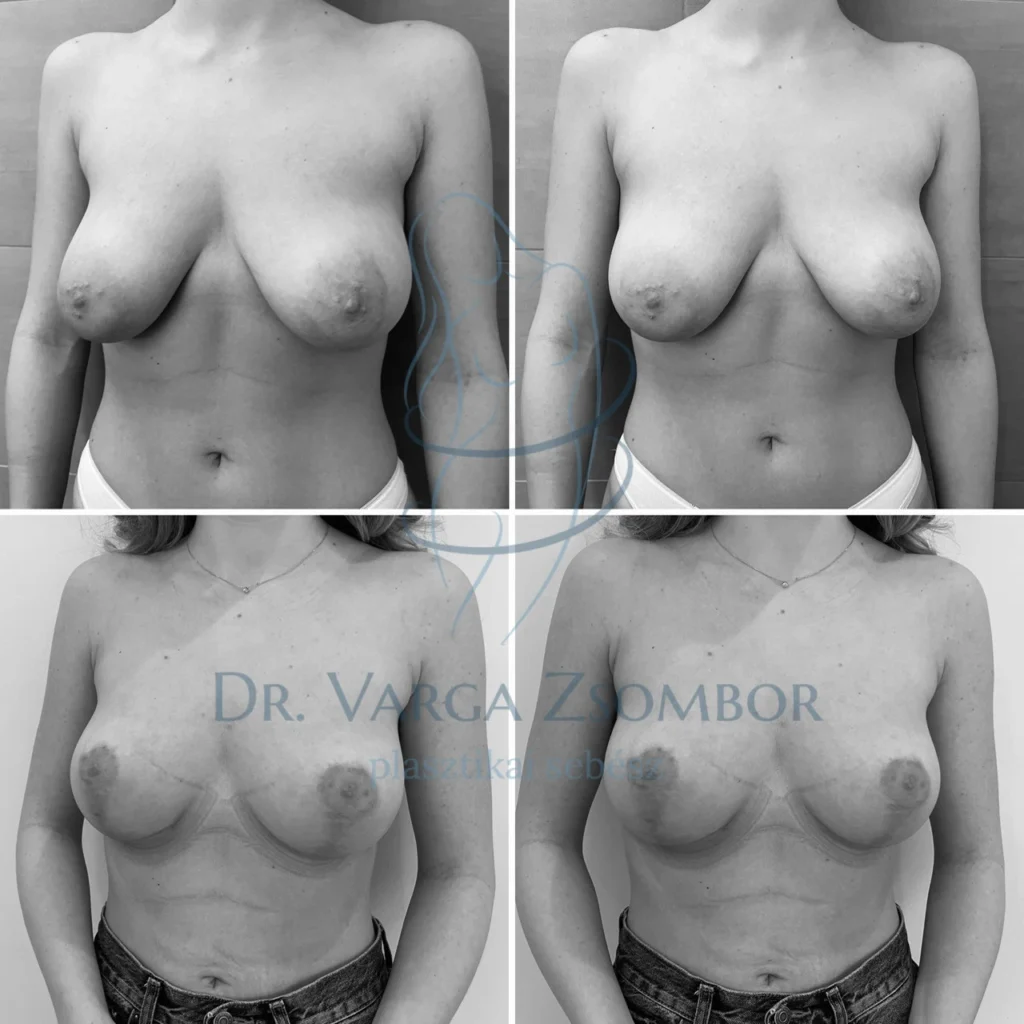 Tubuláris mell újraformázása implantátum nélkül