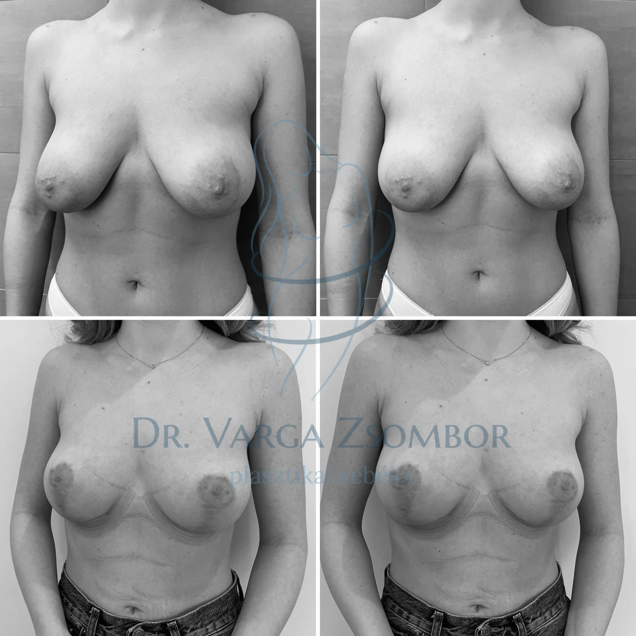 Tubuláris mell újraformázása implantátum nélkül