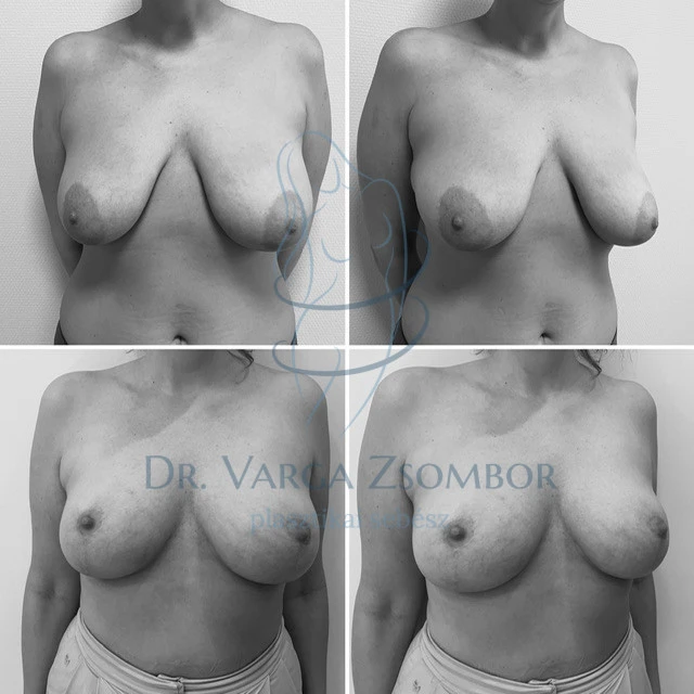 Formás keblek implantátum nélkül-mellfelvarrás után