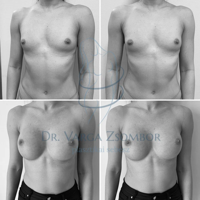 Mellplasztika erős mellizomzat esetén