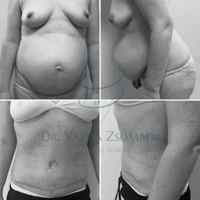 Teljes hasplasztika előtt és után
