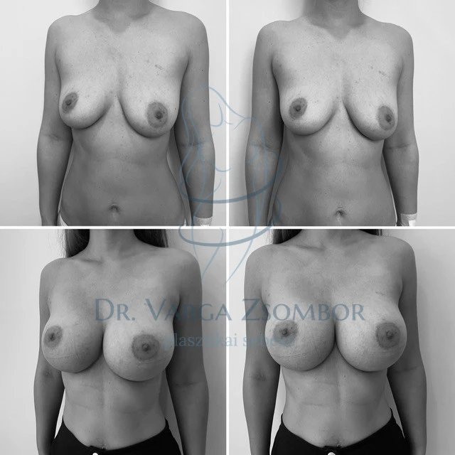 Szoptatás után mellimplantátum? Előtte-utána kép