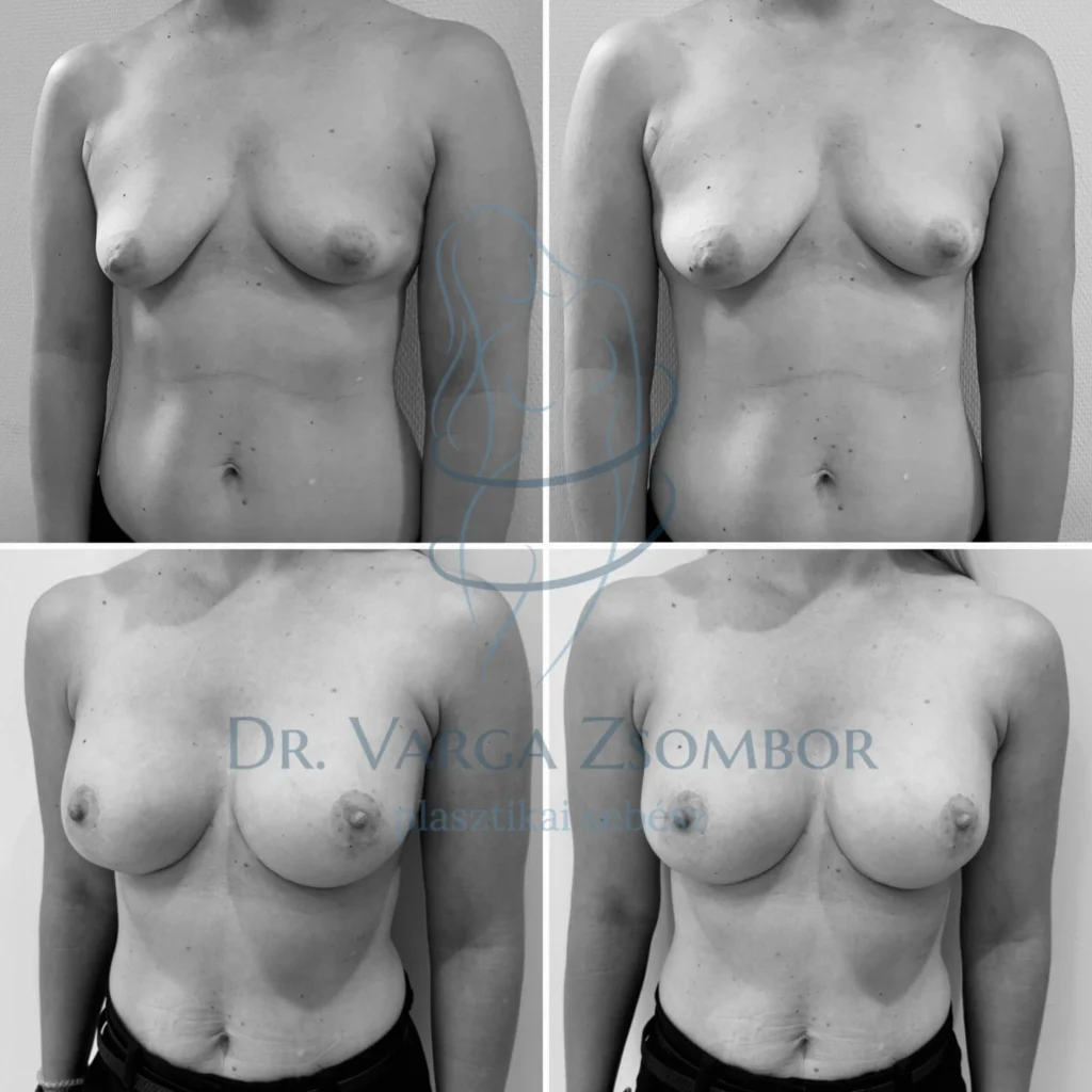 Aszimmetrikus, tubularis emlők plasztikája