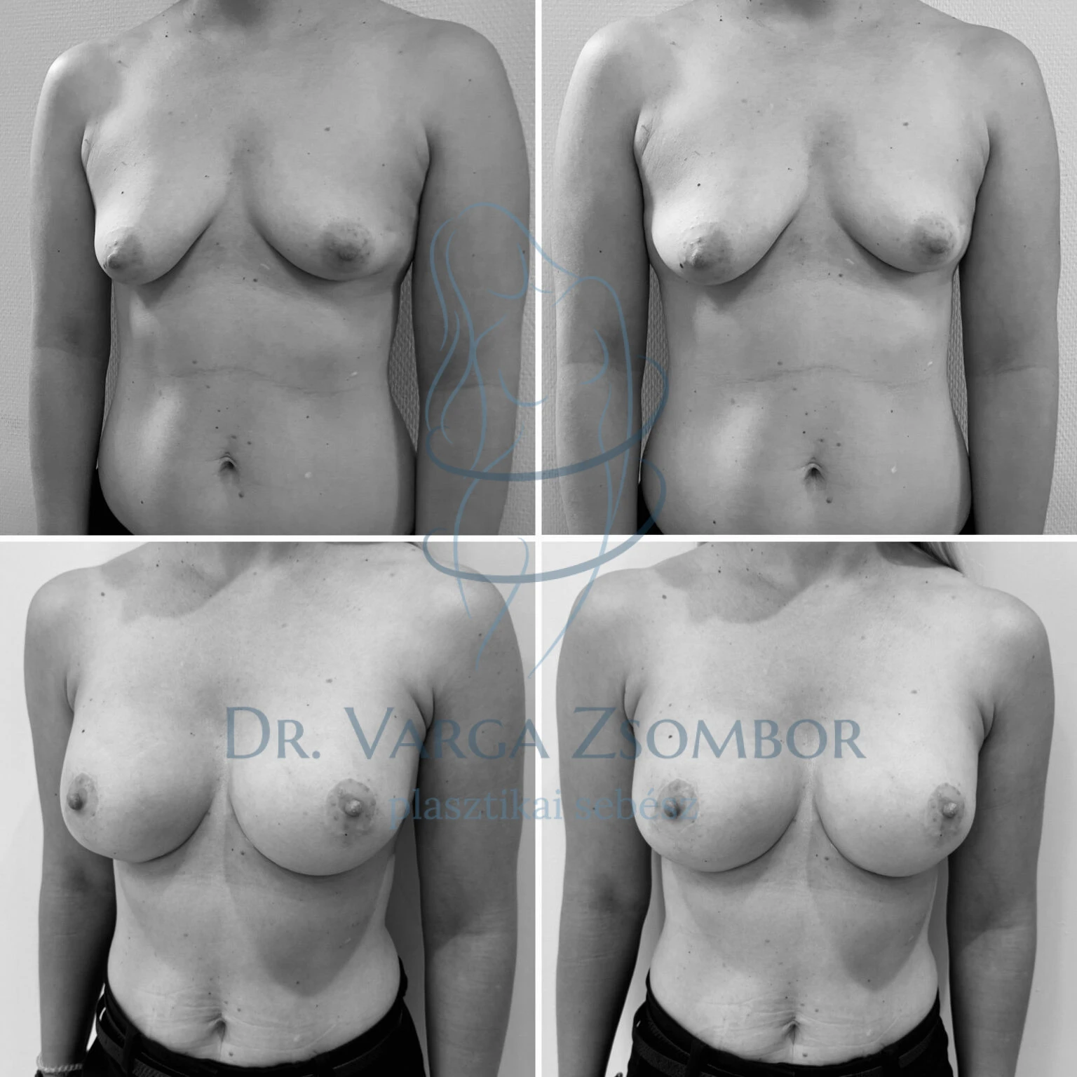 Aszimmetrikus, tubularis emlők plasztikája