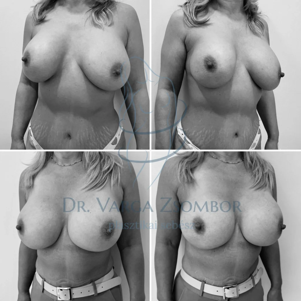 Implantátumcsere teljes tokeltávolítással