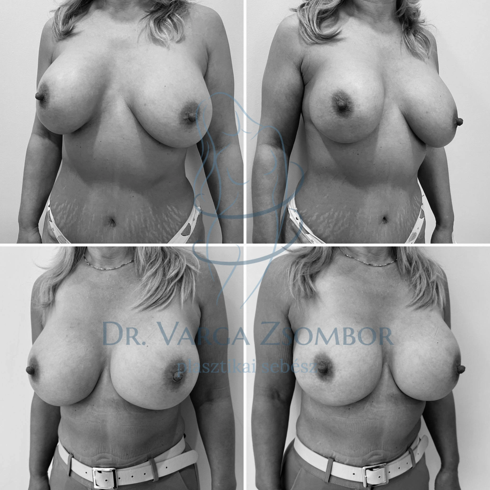 Implantátumcsere teljes tokeltávolítással